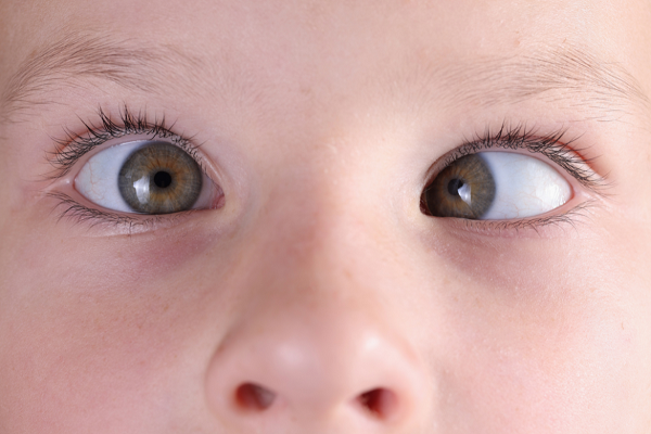 Squint Surgery Corrective Treatment for Misaligned Eyes