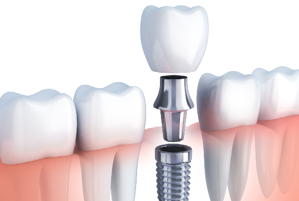 Dentures and Implants