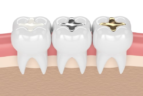 Dental Fillings and Crowns